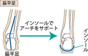 インソールでアーチをサポート